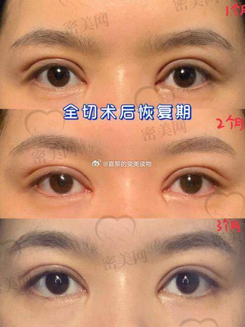 王晓娟埋线双眼皮:优势特色大揭秘