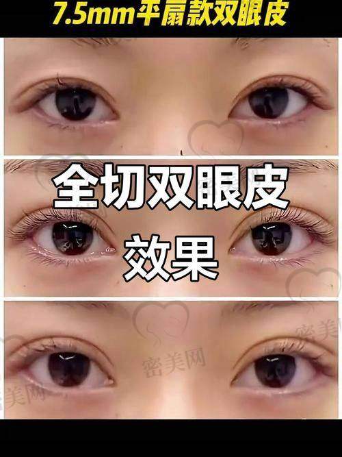 唐山煤医尚美整形医院郭万厚埋线双眼皮的真人实例