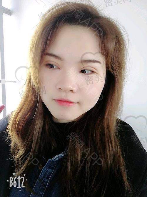 2025年谭敏峰双眼皮修复技术优势曝光