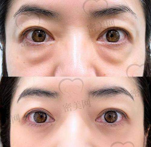 哈尔滨超龙医疗美容医院——专注不开刀去眼袋