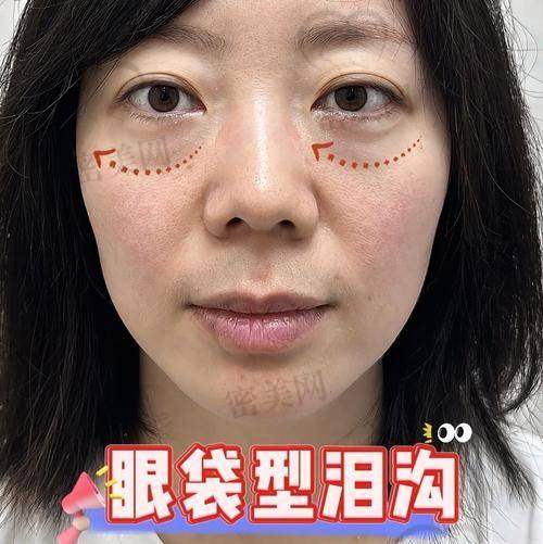 哈尔滨瑞丽整形美容医院——眼袋整形与泪沟填充结合