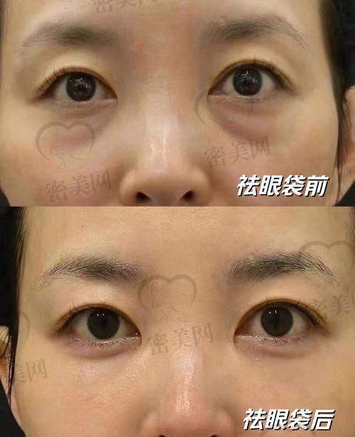 唐山煤醫(yī)尚美整形醫(yī)院郭萬厚祛眼袋:真人實(shí)例超驚艷