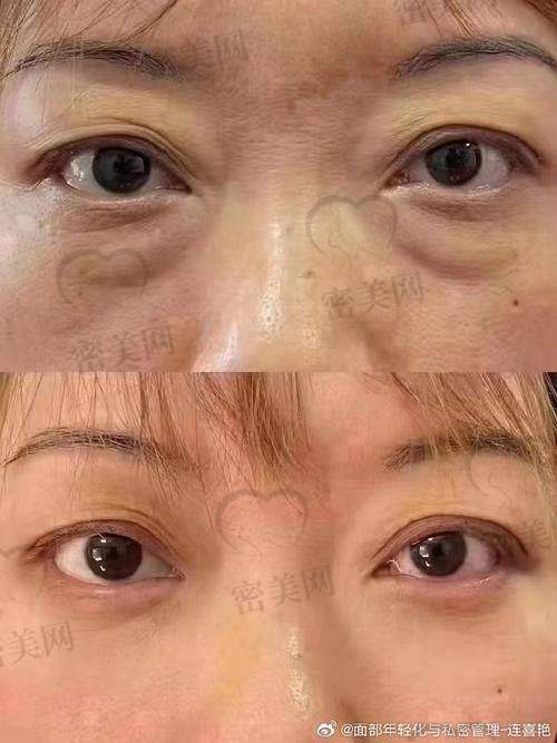 哈尔滨去眼袋好的医院一览表