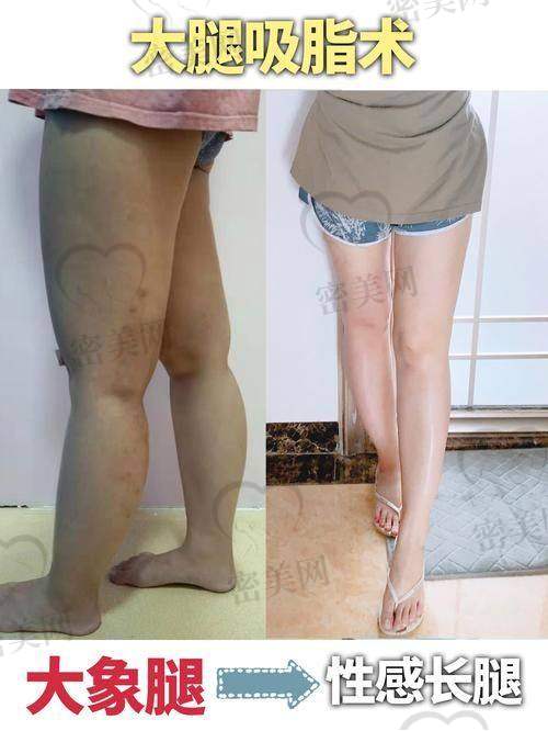 王晓娟大腿吸脂:精细技术的四大神奇优势