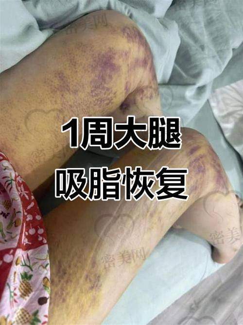 真人实例:8800 元美腿逆袭记