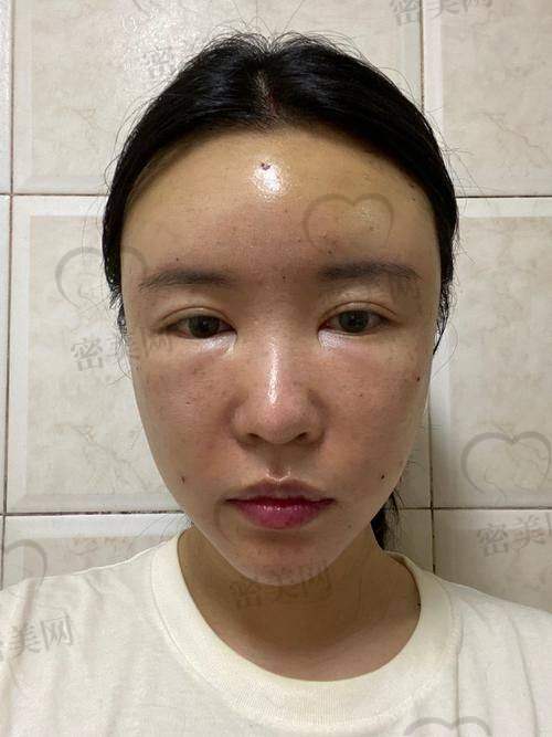 术后修复,惊喜不断