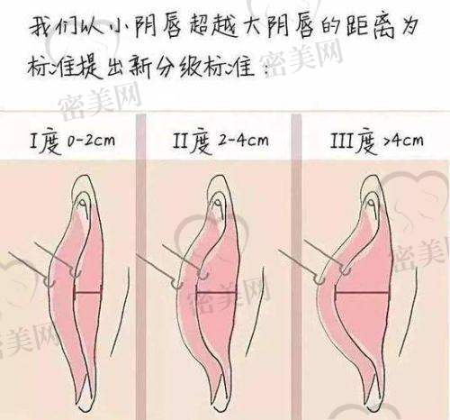 备受关注的“紧缩针”到底体验如何？