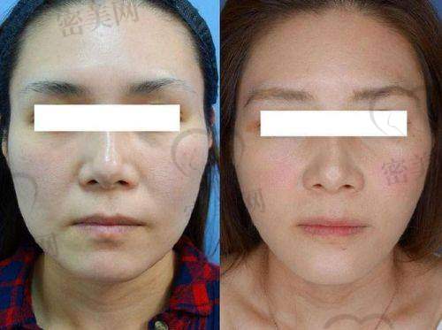 技术特色:杜太超面部拉皮,优势满满!