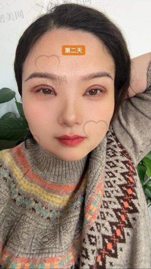 唐山煤医尚美整形医院郭万厚:3800 起埋线双眼皮的价格魅力