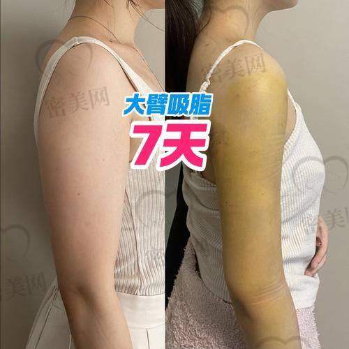 哈尔滨艺星整形吸脂技术怎么样?吸脂到底靠不靠谱