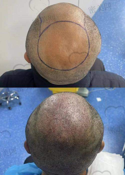 福州艺星植发中 心:医美+植发双向加持,适用于追求形象融合者