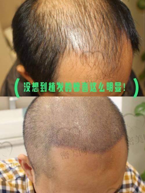 福州曙光医疗美容医院毛发科:定制服务,术前模拟植发成型成效