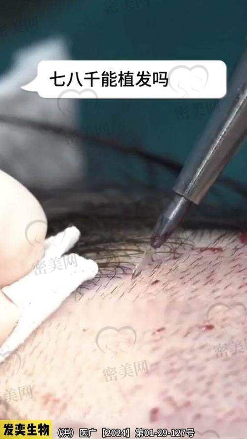 福州恒美毛发中 心:西式审美引导,术后规范化修复