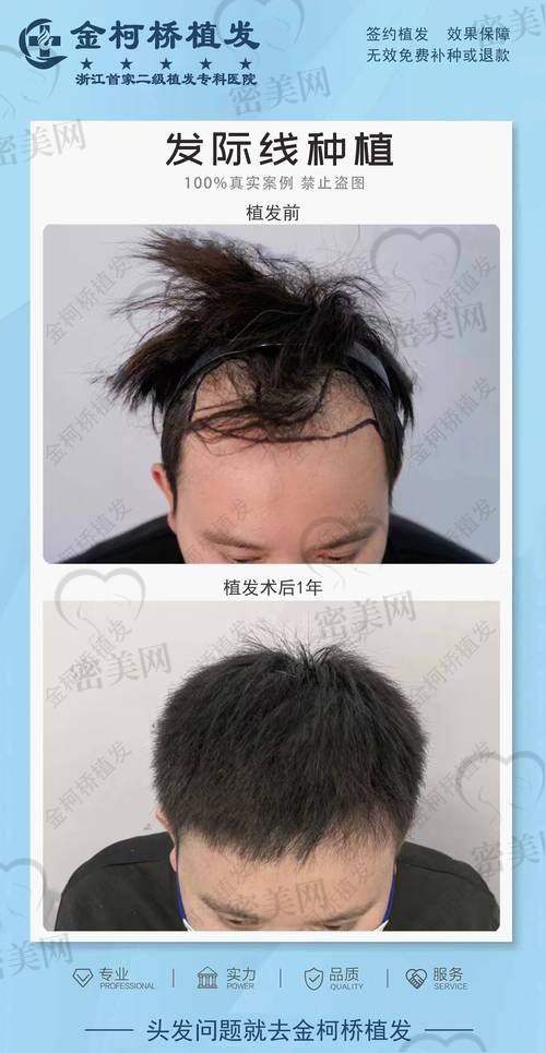 雍禾植发医生团队如何?上海有没有大拿坐诊?