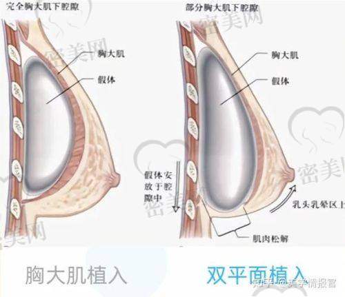 总结:这次隆胸太值啦