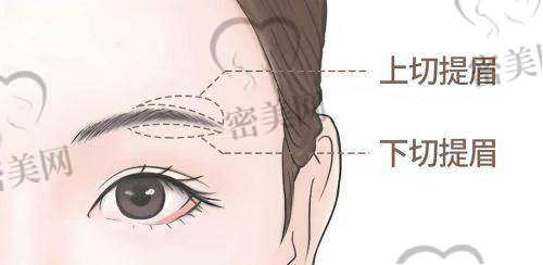 真人实例:王晓娟切眉成效惊艳全场