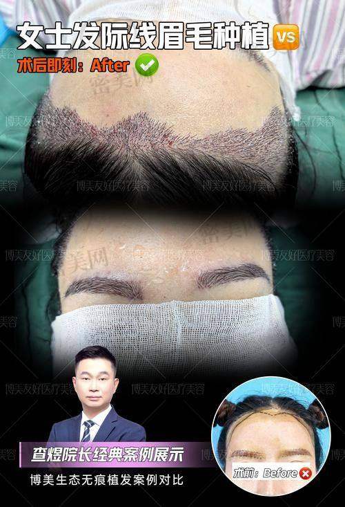 唐山煤医尚美整形医院郭万厚切眉:口碑评价超棒!