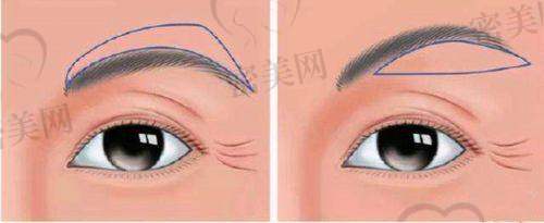 唐山煤医尚美整形医院郭万厚切眉:价格香到离谱!