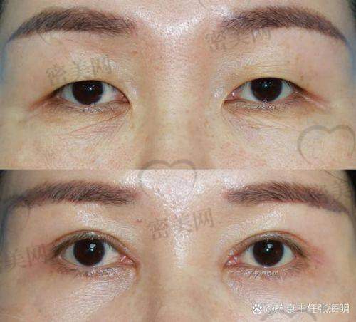 唐山煤医尚美整形医院郭万厚切眉:优势特色大揭秘!