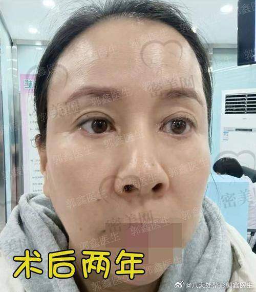 别再犹豫:唐山煤医尚美王晓娟切眉等你来