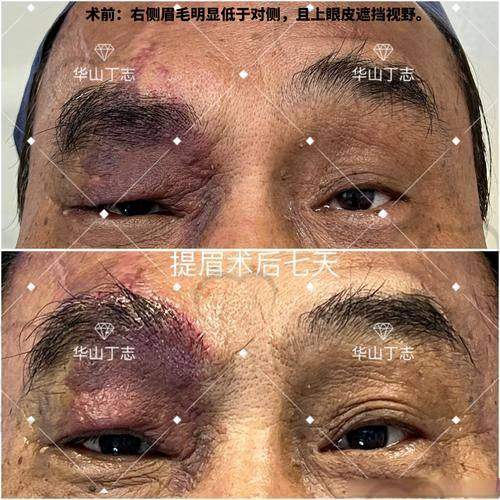 唐山煤医尚美王晓娟切眉:白菜价换眼部新生