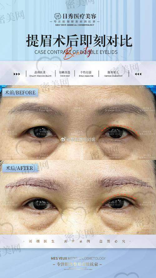 唐山煤医尚美整形医院郭万厚切眉:真人实例超惊艳!