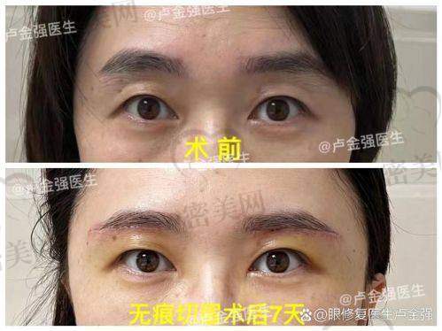 唐山煤医尚美:切眉项目的“秘密武器”