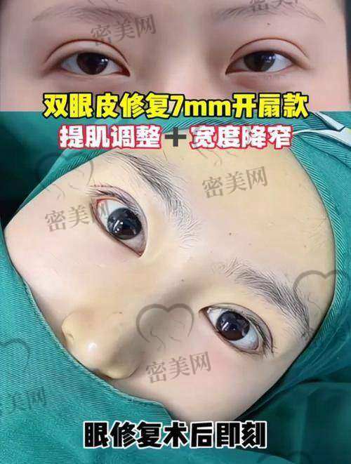口碑爆棚:唐山煤醫(yī)尚美郭萬厚切開雙眼皮的“美麗見證”