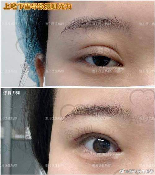 真人实例:王晓娟埋线双眼皮的神奇成效