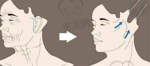 上海旗美医疗美容不是渠道医院，走的是直营路线