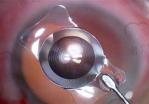 兰州爱尔眼科就诊费用和检查费用