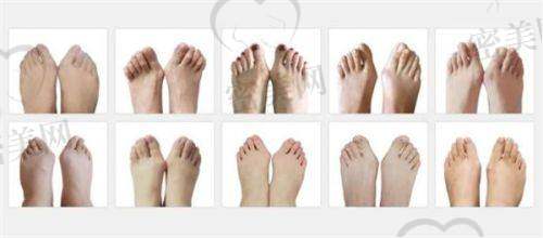 温建民医生简介:拇外翻领域的“技术天花板”