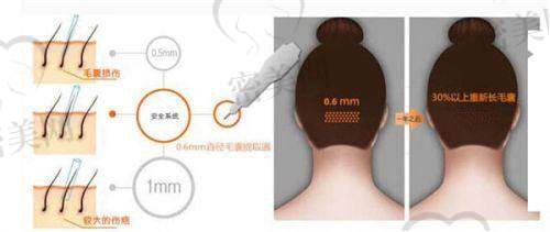 合肥曙光植发医院的医生团队实力如何？