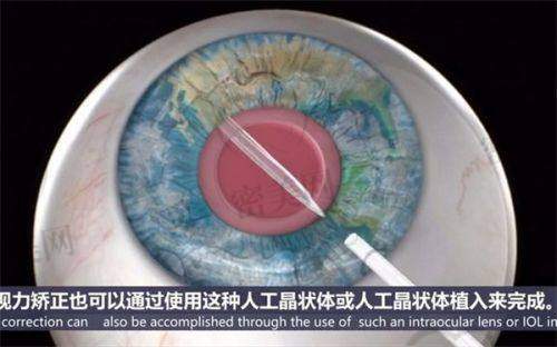 乌鲁木齐普瑞眼科医院近视防控镜价格：全天佩戴更方便