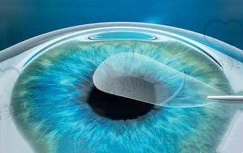 配镜人群建议：不同需求选配镜方案推荐