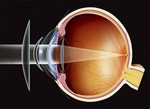 兰州爱尔眼科OK镜/角膜塑形镜价格一览