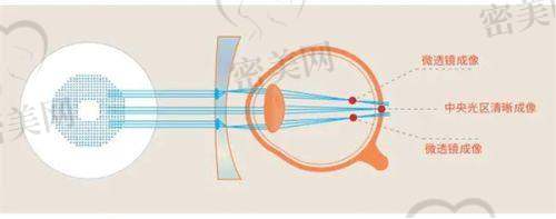 兰州爱尔眼科医院白内障手术费用详解
