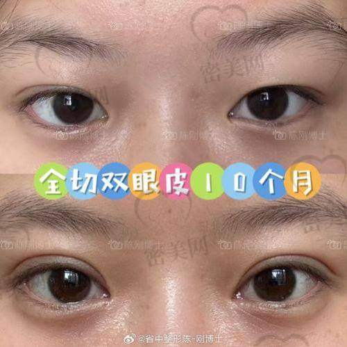 上海时光医疗美容 余东医生：雕刻级剥离术，闭眼痕消除率极高