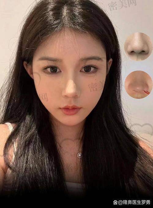 成都米兰柏羽 陈倩医生:露鼻孔矫正骨干医生