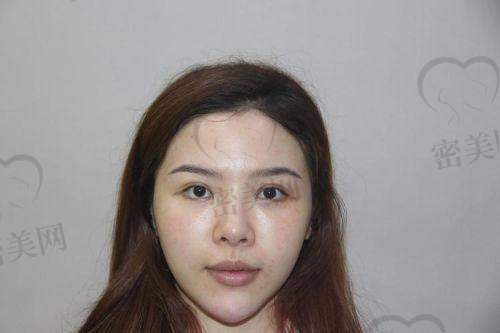 成都艺星 周顺波医生:L型假体隆鼻修复得力军