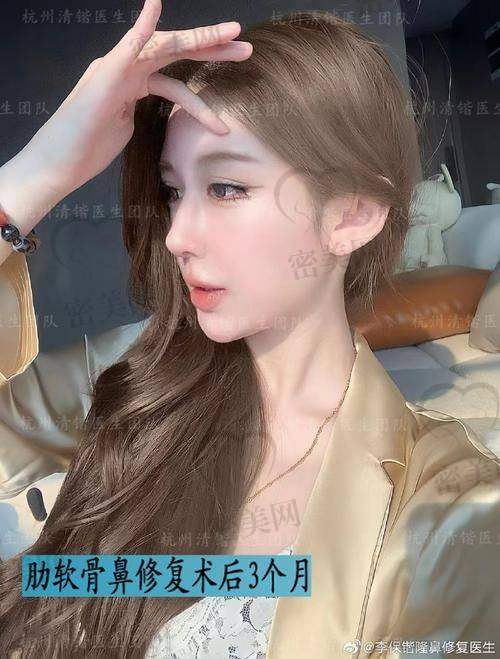 成都军大医院 任义医生:妈生感自然鼻+鼻修复风格代表