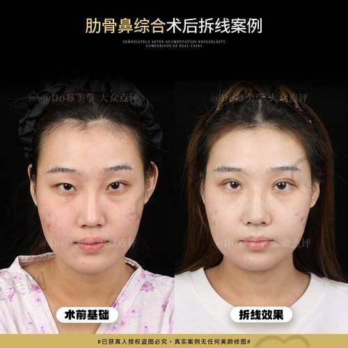 价格参考表:成都部分鼻整形医生费用对比