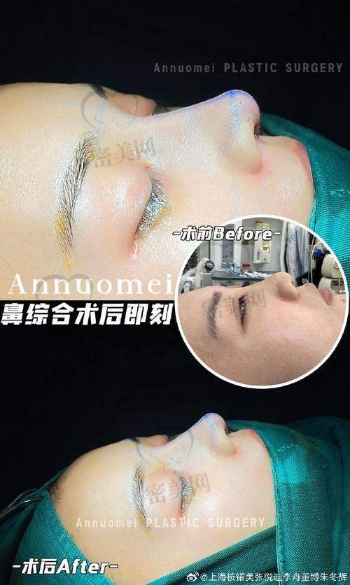 成都大象致颜 周柯医生:擅长处理鼻挛缩、自然延展型鼻子