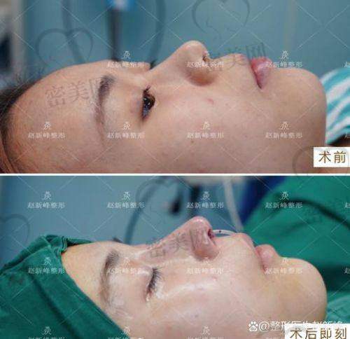 成都东篱整形 李竞医生:自然派NS骨雕鼻代表