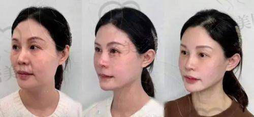 持久力大比拼:玻尿酸半年VS少女针3年,结果显而易见