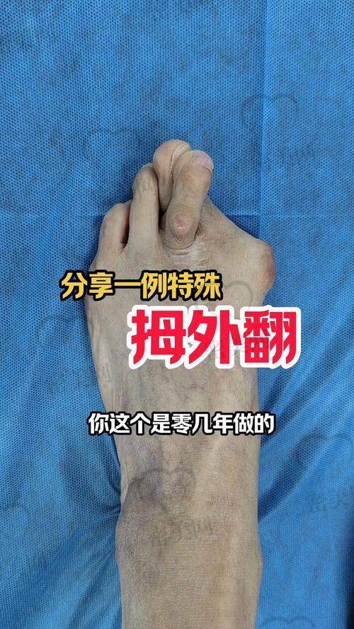 拇外翻非小事,早治才是“王道”!