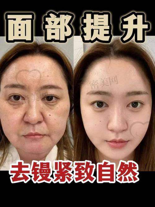 拉皮项目这么多,王志坚医生怎么“对症下刀”?面部松弛程度决定术式选择