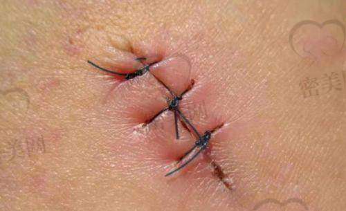 医生团队介绍：深圳鹏程医院疤痕科有哪些靠谱骨干医生？