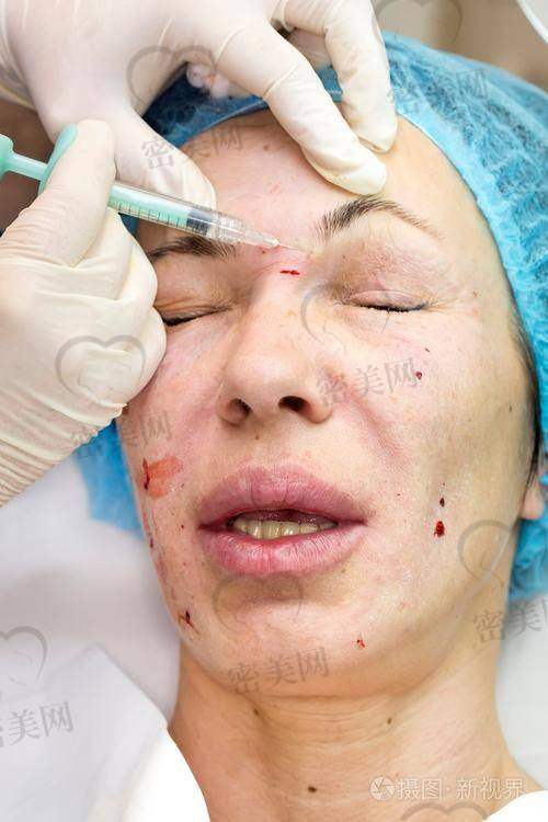 参考一下:馒化脸修复价格区间大揭秘