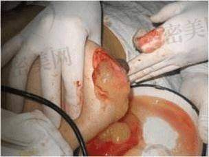 术后护理决定成效80%?答对了!